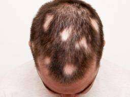 Alopecia Hair Problem Treatment Course
