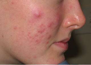 Acne & Pimples Treatment Course