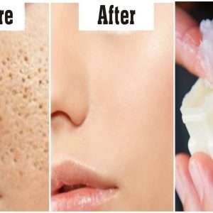 Open Pores On Face Treatment Course